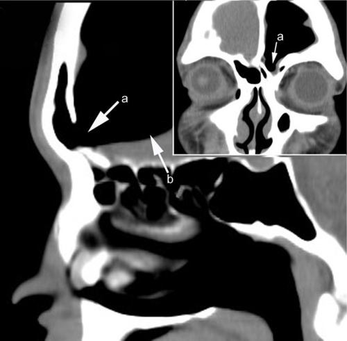 Figure 1 CT image in the sagittal and coronal plane: a, big defect of the posterior table of the FS; b, pneumoencephalos.
