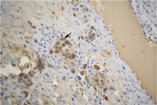 Figure 2 Immunohistochemical staining showed that the tumor cells were positive for human chorionic gonadotropin (hCG) (original magnification ×150).