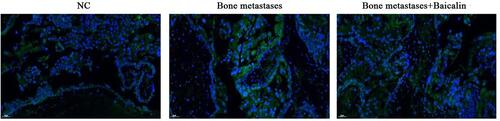 Figure 3 Baicalin inhibited the expression of iNOS in the Bone metastases cancer. iNOS was reported to be related with tumor metastasis. Fluorescein isothiocyanate (FITC) was labeled and showed bright yellow green fluorescence under fluorescence microscope. Immunofluorescence detection revealed that the expression of iNOS was significantly increased in the Bone metastases group and decreased after Bone metastases + Baicalin.