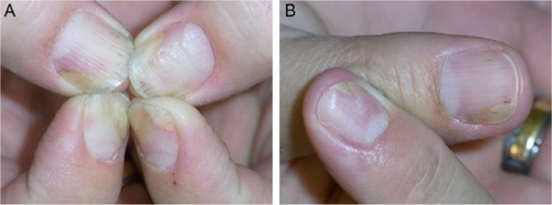 Figure 2 Further development of the nail psoriasis.