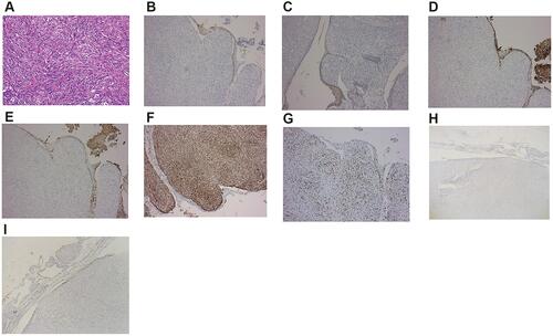 Figure 4 Pathological features of the carcinoma of pelvic neoplasms: (A) H&E showing abundant fibroblastic epithelioid cells densely arranged in cords, nests, or sheets within a collagenous extracellular matrix; (B) positive immunostaining in tumor cells with CK5/6 (focal +); (C) positive immunostaining for CK-HMW (focal +) in tumor cells; (D) positive immunostaining for CK7 (focal +) in tumor cells; (E) positive immunostaining in tumor cells with CK8/18 (focal +); (F) intense positive immunostaining in tumor cells with Vim (+++); (G) tumor cell proliferation rate as determined by Ki-67 immunostaining showed 85% of positive cells; (H) negative immunostaining in tumor cells with CD 10; (I) negative immunostaining for SMA in tumor cells.