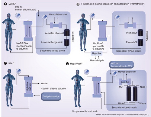 Figure 6. The different nonbiological liver support devices.(A) A representive scheme of the MARS® device. Blood of the patient passes through a hollow-fiber dialysis module where it is dialyzed across an albumin-impregnated polysulfone membrane (MARS Flux dialyzer; membrane thickness: 100 nm; pore size: 50 kDa, surface area: 2.1 m2), which enables the exchange of water-soluble and protein-bound toxins by an albumin-coated membrane against a dialysate containing ‘recycled’ exogenous albumin. The membrane transiently absorbs and holds the toxins. The toxins are released upon contact with the membrane according to the concentration gradient and are carried to the other side of the membrane, where dialysis against the albumin-rich dialysate (600 ml of 20% human albumin) removes the toxins from the membrane. The toxin-enriched albumin solution is then first passed through another dialyzer countercurrent to a standard buffered dialysis solution, where clearance of water-soluble substances occurs by diffusion. The solution is then further purified on line from albumin-bound toxins by incorporation of unspecific adsorbents (an anion exchanger column and an uncoated charcoal column), resulting in regeneration (recycling) of the dialysate, allowing re-uptake of new toxins from the blood. (B) A representive scheme of the Prometheus® device. The first filter in the Prometheus device is the AlbuFlow®, which is made of polysulfone hollow fibers and is permeable to albumin (sieving coefficient: 0.6), and hence to albumin-bound substances. Subsequently, the albumin filtrate (and all molecules equal to the size of albumin) in the fractionated plasma separation and adsorption circuit is perfused through a column with neutral resin (prometh01) and a second column with an anion exchanger resin adsorber (prometh02), whereby the bound toxins are captured by direct contact with the high-affinity adsorbing material. The ‘native’ albumin is then returned to the patient. The FPSA recirculation circuit is driven by a roller pump at 300 ml/min. Finally, after passage through the AlbuFlow, the patient’s blood is dialyzed through a high-flux dialyzer (FX50), whereby water-soluble toxins are eliminated. (C) A representive scheme of the single-pass albumin dialysis device. A standard renal replacement therapy machine is used to run the circuit. Plasma from a reservoir is dialyzed against a low concentration albumin solution, which is disposed after a single pass. (D) A representive scheme of the HepaWash® device. Toxins in the patient blood dissociate from blood albumin, cross the filter membrane and bind to the exogenously added albumin in the dialysate of the secondary closed circuit. It first passes over a classic dialyzer countercurrent to a standard buffered dialysis solution, where clearance of water-soluble substances occurs by diffusion. Afterwards, albumin-bound toxins are removed over two absorbers, which is enhanced by pH and temperature changes through which the albumin can be regenerated. The recycled albumin can therefore be continuously re-used in one treatment session to eliminate toxins from the blood.FPSA: Fractionated plasma separation and adsorption; MARS: Molecular adsorbent recirculating system; SPAD: Single-pass albumin dialysis.