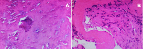 Figure 2 Histopathologic analysis showed fibrocartilage tissue calcification and degeneration, necrotic intervertebral disc tissue, fibrovascular hyperplasia, and focal aggregation of inflammatory cells (A and B).