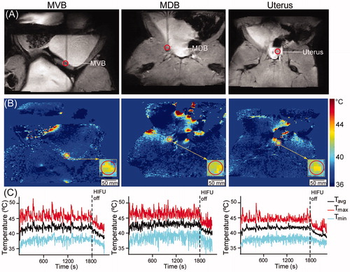 Figure 2. (A) Illustration of the target region-of-interest selection indicated by the red circle on the axial MRIs (target slice) for three different treatment locations. From left to right: muscle adjacent to the ventral wall of the urinary bladder (MVB), muscle adjacent to the dorsal wall of the urinary bladder (MDB), and the uterus. (B) The representative average temperature map of the axial plane (target slice) of the three pelvic targets. (C) The representative average temperature (Tavg), maximum temperature (Tmax), and minimum temperature (Tmin) during the 30-min HT session and the 5-min cooling periods.