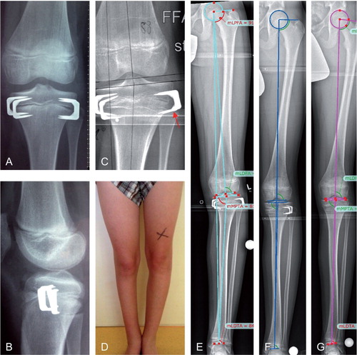 Figure 6. Secondary angular deformity. A and B. Accurate tibial stapling for LLD correction. C. Loosening of the lateral staples with subsequent varus deformity. D. Clinical picture with varus deformity of the left leg. E. Long, standing anteroposterior radiographs confirming the pathological (varus) mechanical axis. F. Correction of the mechanical axis 6 months after removal of staples from the concave side and replacement of staples at the convex side. G. Mechanical axis at the time of follow-up (FU).