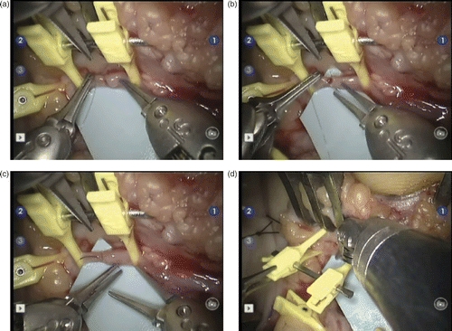 Figure 3. The operating surgeon's view of the procedure on the control screens. The operative field corresponds to the distal anastomosis of the inverted venous graft (at right) with the distal end of the ulnar artery (at left). The vascular clamp is maintained by Pott scissors (at top). (a) The Black Diamond forceps on the right exerts a slight pressure on the wall of the venous graft to facilitate passing the needle and nylon 10/0 thread through the lumen of the ulnar artery distal end with the other Black Diamond forceps on the left. (b) The forceps on the right is about to grab the end of the needle which is still held by the left forceps. (c) The forceps on the left regains its hold on the end of the needle before knot tightening. (d) Once the anastomosis is achieved, the left forceps exerts some pressure on the clamp to release the distal end of the ulnar artery. The right forceps exerts a slight pressure on the venous graft wall to facilitate clamp removal.