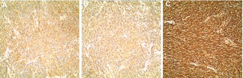 Figure 4 Immunohistochemical staining of gastrointestinal stromal tumor with DOG1 (A), CD117 (B), CD34 (C).