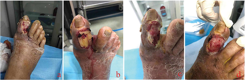 Figure 4. In the initial treatment of diabetic foot ulcer wounds, sufficient debridement was given to completely remove necrotic tissue. Tendons and bones were exposed after the debridement of most toe wounds (a the first day after debridement). The first day after debridement (b), we used L-PRF to cover the wound. The third day after debridement (c), we again performed wound dressing and covered the wound with L-PRF. The 5th day after debridement (d), after removing the wound dressing we can see that the wound surface was tidy, the wound area was slightly reduced, no necrosis and abnormal secretions were seen.