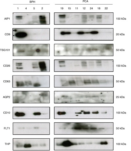 Fig. 5.  Western blot analysis of Norgen-enriched uEVs from BPH and PCA urine samples. NOR methodology was employed to enrich uEVs from urine samples of BPH and PCA patients as described in Materials and Method section. Indicated proteins were analysed using Western blotting. Molecular weights are indicated.