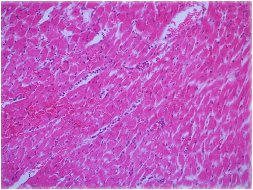 Fig. 3 Extensive inflammatory cell infiltration and edematous myocardial tissue in the diabetic ischemia reperfusion group, HEx200.