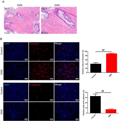 Figure 2. Pathology of EMS in rats and expression of the EMT related proteins in EMS cells. (A) HE staining was used to observe the pathology of the endometrium of the EMS rats (magnification, 40×, scale bar: 400 μm; 100×, scale bar: 200 μm). (B) Expression of the vimentin and E-cadherin was tested by IF to identify the cells that was cultured from the rats (magnification 200×, scale bar: 100 μm), and the chart was calculated. n = 3 in each group, ##p < .01 vs. control group. EMS: endometriosis; EMT: epithelial–mesenchymal transition; HE: hematoxylin and eosin; IF: immunofluorescence.