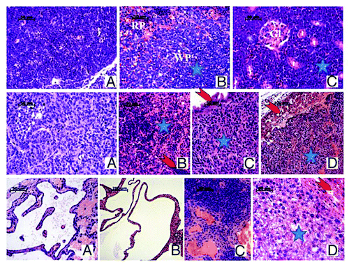 Figure 3. Representative images of H&E staining of tumors detected in mice of all 3 genotypes. Top row: Lymphoma in irradiated Per1−/− male mouse: large tumor of expansively proliferating uniform neoplastic lymphoid cells encompasses the thymus and mediastinal space (A) and has spread in the white pulp (WP) and partially in the red pulp (RP) of the spleen (B), in the kidney with only single glomeruli (Gl) and tubules(t) remaining visible among the proliferating neoplastic cells(star) (C) and liver (not shown), effacing the normal morphology of these organs. Middle row: Malignant granulosa cell ovarian tumors, found in female mice of all 3 genotypes: monotonous neoplastic cells with clear cytoplasm and rounded or oval nuclei forming follicles, cords, or bands with scanty stroma in between (A); metastasis in mesenteric lymph node with neoplastic cells replacing the normal structure(star) and only remnants of normal lymphocytes (arrow) (B); metastasis in intestinal wall (star) with intact enterocytes(arrow) separating it from the lumen(upper left) (C); metastatic growth(star) in liver leaving thin layer of normal hepatocytes (arrow) (D). Bottom row: Ovarian cystadenoma in irradiated Per1−/− female mouse (A): interconnected spaces lined by a single layer epithelium on mostly acellular underlying stroma; bile duct cystadenoma in liver of irradiated Per2−/− female mouse (B): various in size cysts lined with cuboidal or flattened secreting epithelial cells on mesenchymal stroma or liver parenchyma with normal liver tissue in the right lower corner; Hemangiosarcoma in spleen of irradiated Per1−/− female mouse (C): the normal spleen morphology (upper right) is replaced by variably-sized endothelium-lined vascular spaces (lower right); Hepatoma in liver of irradiated Per2−/− male mouse: rows and plates of well differentiated neoplastic cells (blue star) grow expansively and compress the adjacent normal liver (red arrow).
