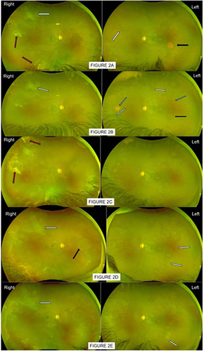 Figure 2 (A) Patient 2 first attended eye casualty in 2020 December, aged 12 having referred by optician for queried Right eye retinal detachment, left odd retinal lesion. Patient was asymptomatic. Assessment confirmed excellent vision 6/5 each eye, both eyes had auto-infarcted seafans scars on traction (white arrows). Right eye had vitreous hemorrhage (red arrows), flat retina. Left eye lesion previously queried by optician was a salmon patch in mid-temporal retina (black arrow). Patient was referred to specialist sickle eye clinic for management. (B) In 2021 April clinic assessment, vision remains good at 6/5. Both eyes had auto-infarcted seafans on traction as previously seen but also numerous smaller new sprouts of seafans (white arrows, better seen on slit-lamp). Right eye still limited view but clearer as old vitreous hemorrhage gravitated, flat retina, no fresh bleed. Left eye had no vitreous hemorrhage, previous salmon patch in mid-temporal had resolved, seen as a round shadowy mark (black arrow), revealing no underlying seafan. There were other smaller salmon patches in resolution (grey arrows). Patient was advised and received limited barrier laser to Right eye tractional seafan (supero-temporal) to reduce risk of retinal detachment in future traction bleeds, and additional sector laser around new sprouting seafans. Left eye was to be observed. (C) Patient 2 reattended 4 months later with fresh bleed in Right eye giving hazy fundus view, localized supero-temporal traction bleed was heavier (red arrow). Both eyes maintained good vision 6/6 as center macula was clear, retinae were also flat. Left eye numerous small seafans on traction, some were larger in size, but no evidence of vitreous hemorrhage. Patient was advised and received sector/barrier laser treatment to Left eye seafans but additional laser treatment to Right eye was not possible at this visit due to poor view. (D) Having missed a few appointments, patient was re-examined 10 months later (2022 June), maintained good vision 6/6 and improved Right eye floaters. Fundoscopy of Right eye however remained a struggle although improved; previous supero-temporal tractional seafan scar appeared more extensive and elevated (white arrow), another resolved salmon patch shadow (black arrow) was seen in nasal retina. Left eye had new active seafans, not yet elevated (white arrows) around previous resolved salmon patch; previous treated lesions appeared adequate, no evidence of vitreous hemorrhage yet in this eye. Left eye received further sector laser; Right eye was to await for further vitreous hemorrhage clearing to allow any possible effective laser top-up. (E) Patient re-attended clinic in 2023 September, having missed a few appointments, attended eye casualty once in 2023 June with further Right eye bleed. Vision was still good 6/7 Right, 6/5 Left. Right eye status relatively unchanged with some new bleed, old bleed slow to resolve; previous supero-temporal traction was mimicking localized retinal detachment but no subretinal fluid and not advancing. Left eye continued to have few more new seafans and residual active tip of an inadequately lasered seafan (white arrow), other adequately treated seafans resolved, no vitreous hemorrhage. Left eye received further sector laser. Plan for Right eye was to perform heavier barrier laser to supero-temporal traction as soon as view was clearer. Consideration for vitrectomy was discussed if rebleed and tractional detachment worsen.