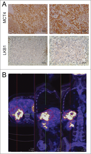 Figure 3. Assessment of metabolic features of liver metastasis. Panel A shows IHC staining of monocarboxylate transporter 4 (MCT4) and liver kinase B1 (LKB1) in the liver metastasis of the patient. Magnifications x100 and x200 were used. This sample is strongly positive for the lactate transporter MCT4 and negative for LKB1. Panel B: PET imaging performed in May 2012 shows strong 18F-FDG uptake in the liver metastasis.