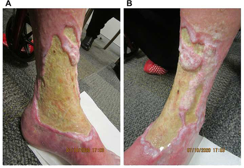Figure 2 Re-epithelialization and reduction in ulcer size at week 8 of tildrakizumab treatment on the (A) medial and (B) anterolateral aspects of the left leg.