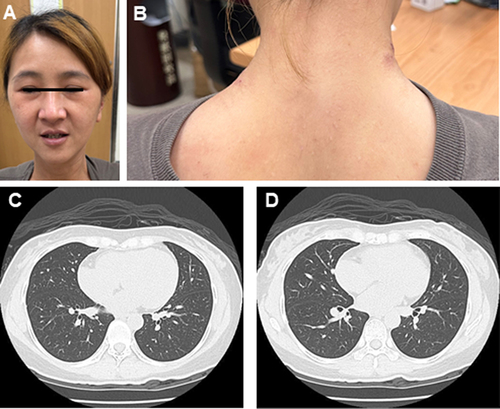 Figure 2 Skin photographs and chest images from an anti-MDA5-positive ADM patient with early-stage ILD after extended-release Tof treatment. Resolved heliotrope rash (A) and shawl sign (B). Resolved bilateral diffuse infiltration with GGO on high-resolution chest CT (C and D).