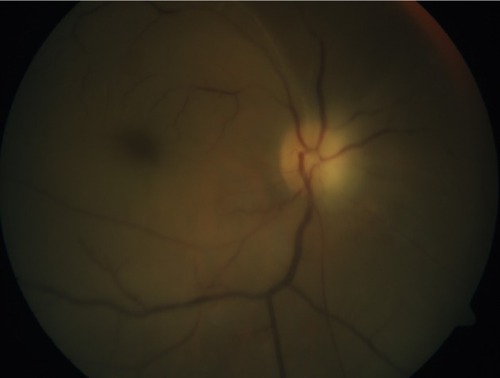 Figure 1 Fundus photo of the right eye showed a slightly pale optic disc, a generalized pale retina, and the presence of a cherry red spot at the posterior pole.