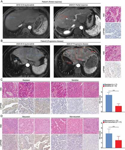 Figure 6. The association between LAPTM5 and response to lenvatinib evaluated by clinical samples. (A) Representative images of MRI, H&E and LAPTM5 of patients with PR. Scale bars: 50 µm. (B) Representative images of MRI, H&E and LAPTM5 of patients with PD. Scale bars: 50 µm. (C) IHC analysis indicated patients sensitive to lenvatinib exhibited lower LAPTM5 levels compared to those resistant to lenvatinib. Scale bars: 50 µm. (D) IHC analysis indicated patients with tumor recurrence exhibited higher levels of LAPTM5 compared to those without recurrence. Scale bars: 50 µm. Data were presented as the means ± S.D. ***, P < 0.001.