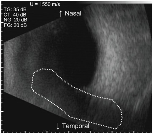 Figure 1 Horizontal scan of a B-scan ultrasonography image of intravitreal gas and choroid elevation with the patient seated on postoperative Day 7. Because of the reflection of the intravitreal gas (dotted outline), B-scan ultrasonography could not image the choroidal elevation, which developed superior to the ocular fundus.