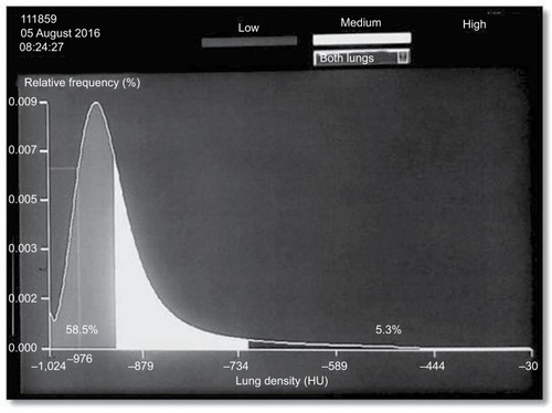 Figure 3 Lung density histogram in 71-year-old man with stable COPD (GOLD III).