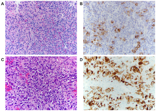 Figure 1 CD30 staining of Hodgkin Lymphoma vs ALCL.