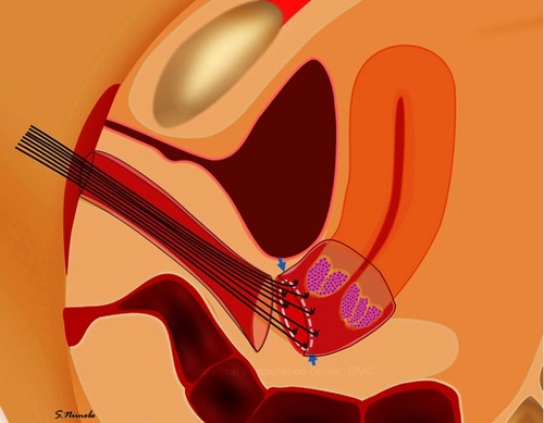 Figure 2 Vaginal closure at laparoscopic radical hysterectomy.Note: Pulling the silk stretches the vaginal cut line. The vaginal mucosa was then cut at 3 mm outside the knot (arrows).