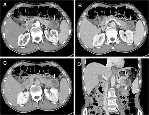 Figure 1 Enhanced computed tomography (CT) reveal one irregular hypoattenuating mass, 4.6×3.7 cm in size with unclear margins, involved the spleen vessels and located at the pancreatic tail. (A) Arterial phase showed inhomogeneous enhancement of the lesion, (B) the portal venous phase showed a mass with ring enhancement, (C) in the delay phase, the ring enhancement of the lesion gradually de-enhanced, (D) the mass with ring enhancement in coronal view.