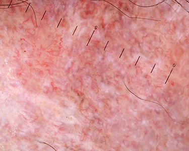 Figure 12 Trichoscopy of scalp discoid lupus erythematosus shows polymorphous vessels.