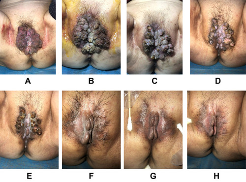 Figure 1 Case 1. (A) Pretreatment photograph showing massive (15 cm × 10 cm) cauliflower-like lesions clustered in the vulva. During the first stage of treatment, the lesion’s size and severity gradually reduced until it had completely disappeared. Photographs taken at (B) 1 week, (C) 4 weeks, (D) 8 weeks, (E) 12 weeks, and (F) 18 weeks. (G) Photograph showing that the lesion is invisible to the naked eye but the VIA is positive 4 weeks into the second stage of treatment. (H) The lesion is invisible and the VIA negative after 3 months of the third stage of treatment.