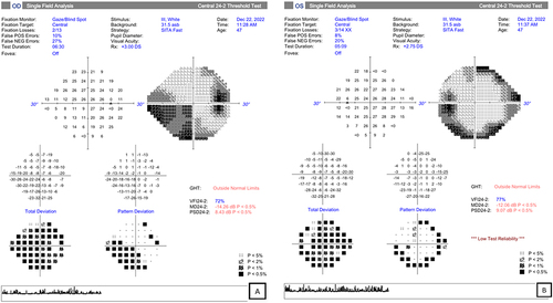 Figure 6 HFA 30–2 test in the right (A) and left (B) eye. Marked scotoma in the right eye with low test reliability of the LE.