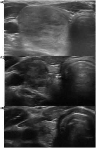 Figure 3. Sonography of one patient with follicular neoplasm before RF ablation (a), and 6-month (b), 12-month (c) post RF ablation.