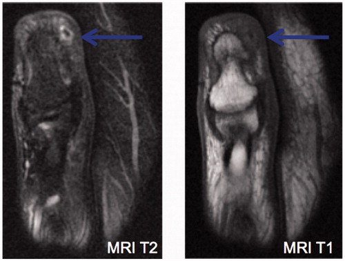 Figure 1. A subsequent MRI was reported as most likely a small foreign body with no evidence of erosion.