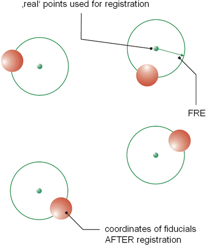 Figure 3. Fiducial registration error (FRE), which is the distance between corresponding fiducial points after registration.
