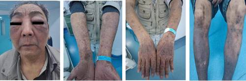 Figure 1 Patient’s skin condition.