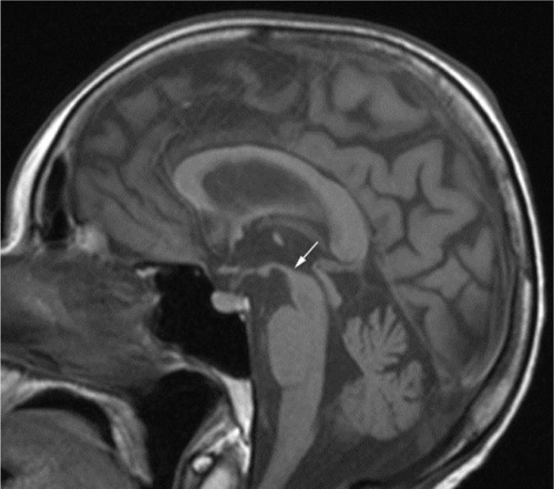 Figure 2 Sagittal spin-echo T1-weighted magnetic resonance images on follow-up examination show mild midbrain atrophy with “hummingbird” sign (arrow).