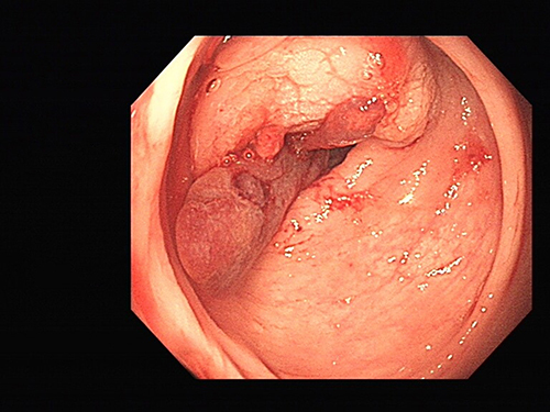 Figure 2 First colonoscopy image.