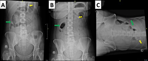 Figure 1 Abdominal X-ray; (A) supine position; (B) half sitting position; (C) left lateral decubitus position. Green arrow showed excessive intestinal air distribution in the right upper abdomen, suspicion of localized ileus at right upper abdomen; yellow arrow showed an NGT position.