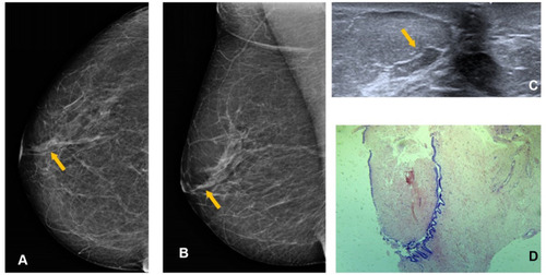 Figure 6 Right mammogram shows SDD (yellow arrow) at cranio-caudal (CC) (A) and medio-lateral oblique (MLO)(B) mammogram view. Targeted US shows intraductal heterogeneous intraductal content (yellow arrow) (C); H&E staining (x10) shows stromal fibrosclerosis (D).