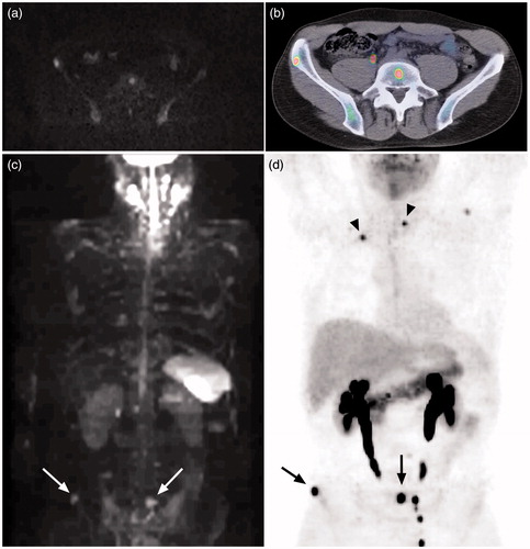 Figure 1. Bone marrow metastases in the lumbar spine and pelvis clearly visualized by both axial diffusion-weighted MRI (a) and 5-HTP PET/CT (b). The lesions in (a) and (b) are indicated (arrows) in MIP-images of diffusion-weighted MRI (c) and 5-HTP PET (d) in the same patient. The lymph node metastasis in thorax and bone marrow metastasis in vertebra Th II (arrow heads) are not detected with MRI (c), but clearly seen with PET (d). Hyperintense normal CNS, salivary glands, spleen, and lymph nodes are also seen in (c). Normal excretion of metabolites to the urinary tract is seen in (b) and (d).