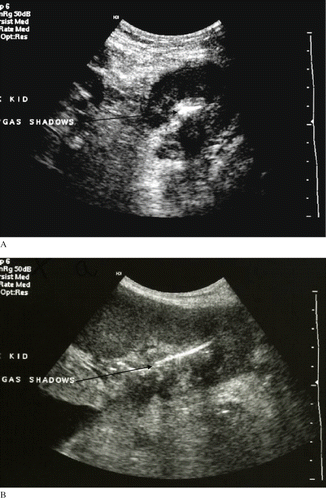 Figure 1. (A) Ultrasound of the graft showing dirty shadows in the pelvi-calycial system; (B)ultrasound of the graft in long axis.