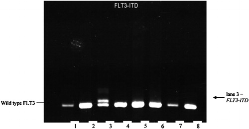 Figure 2. RT‐PCR detection of FLT3‐ITD.