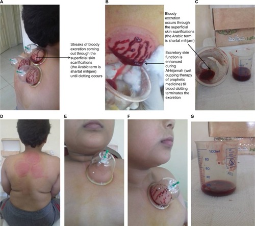 Figure 3 Second suction step is done immediately after skin scarifications.