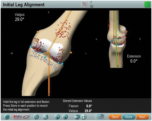 Figure 2. Screenshot from the navigation system showed preoperative alignment of the mechanical axis (29° valgus).