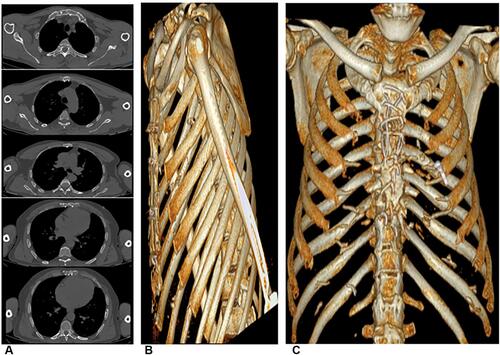 Figure 3 A 60-year-old-diabetic-male patient with sternotomy and received local sternal vancomycin paste. (A) Axial (bone window) images at the five fixed anatomic levels show the sternal halves are well-aligned. The appearance is that of essentially normal bone without gap or obvious osteotomy margin at all five levels. The mean 6-point CT score of sternal healing is 5, denoting complete healing. (B and C) A reformatted 3D image confirms the complete healing.