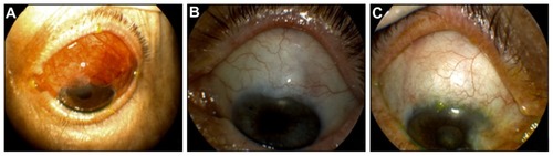 Figure 4 Appearance of elevated amnion shielded trabeculectomy bleb at 1 week post-op (A). Amniotic group blebs at 1 month post-op. The blebs are diffuse, with mild vascularization (B and C).