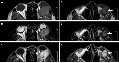 Figure 5 MR scan of Case 4 (2nd operation). Arrows show signal tubular structures, which might represent fast-flow vessels within the tumor.Notes: (A, D) T1 image, (B, E) T2 image, and (C, F) post-contrast T1 image.