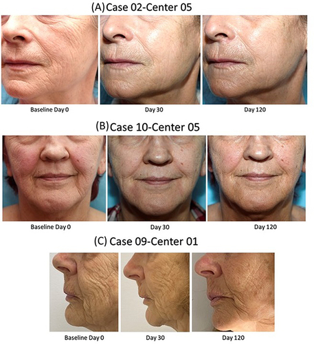 Figure 7 Before-after photos. Exemplary photographs illustrating before the treatment. (A) A female subject with a baseline score of 5 on the Bazin cheek folds wrinkle scale (left photo, D0) and after the treatment with three vectors with a score of 2 at D30 (middle photo), and a score of 1 at D120 (right photo). (B) The before-after photos on nasolabial fold of a female subject with the score of 5 on the Bazin nasolabial fold score at baseline (left photo) which decreased to score 3 at D30 (middle photo). This score remained stable at 3 at D120 (right photo) (C) The before-after photos of a female subject on cheek folds with a score of 7 on the Bazin cheek fold scale at baseline (left photo) which decreased to 5 at D30 (middle photo) and to 4 at D120 (right photo).