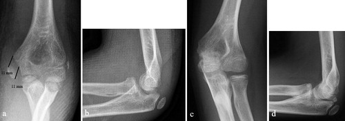 Figure 2. a, b. 11.8-year-old boy with 11 mm displaced fracture of the medial humeral epicondyle, which was treated with an above-elbow splint for 3 weeks. c, d. He had returned to climbing without pain and his elbow was stable with a full range of motion at 4 years from injury.