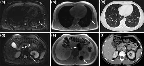 Figure 1. Follow-up MRI and CT, approximately three years after completion of treatment in a 26-year-old man with clinical stage IV testicular cancer. Axial T2-BLADE (a), T1-Dixon (b) and CT image (c) show a residual lung lesion at the base of left lung. The lesion was negative on DWI, or previous 18F-FDG PET/CT (not shown). Axial T2-BLADE (d), T1-Dixon (e) and CT (f) image show no residual lymphandenopathy. Some susceptibility artifacts (arrows), due to metal clips deteriorate the image quality in image d and e.