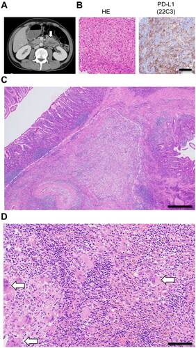 Figure 2. Clinical and pathological images of the duodenum. (A) Computed tomography image showing duodenal wall thickening (arrow). (B) More than 50% of tumor cells with a pleomorphic appearance are positive for PD-L1 (clone: 22C3). (C) Low-power field image of the resected duodenum specimen with HE staining. An epithelioid granulomatous lesion is observed in the submucosa (within the dotted line). Bar, 500 μm. (D) High-power field image of the epithelioid granulomatous lesion with prominent lymphocyte infiltration. Arrows indicate multinucleated giant cells. Bar, 100 μm.